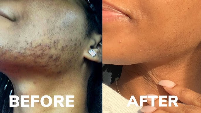 Laser Hair Removal Results